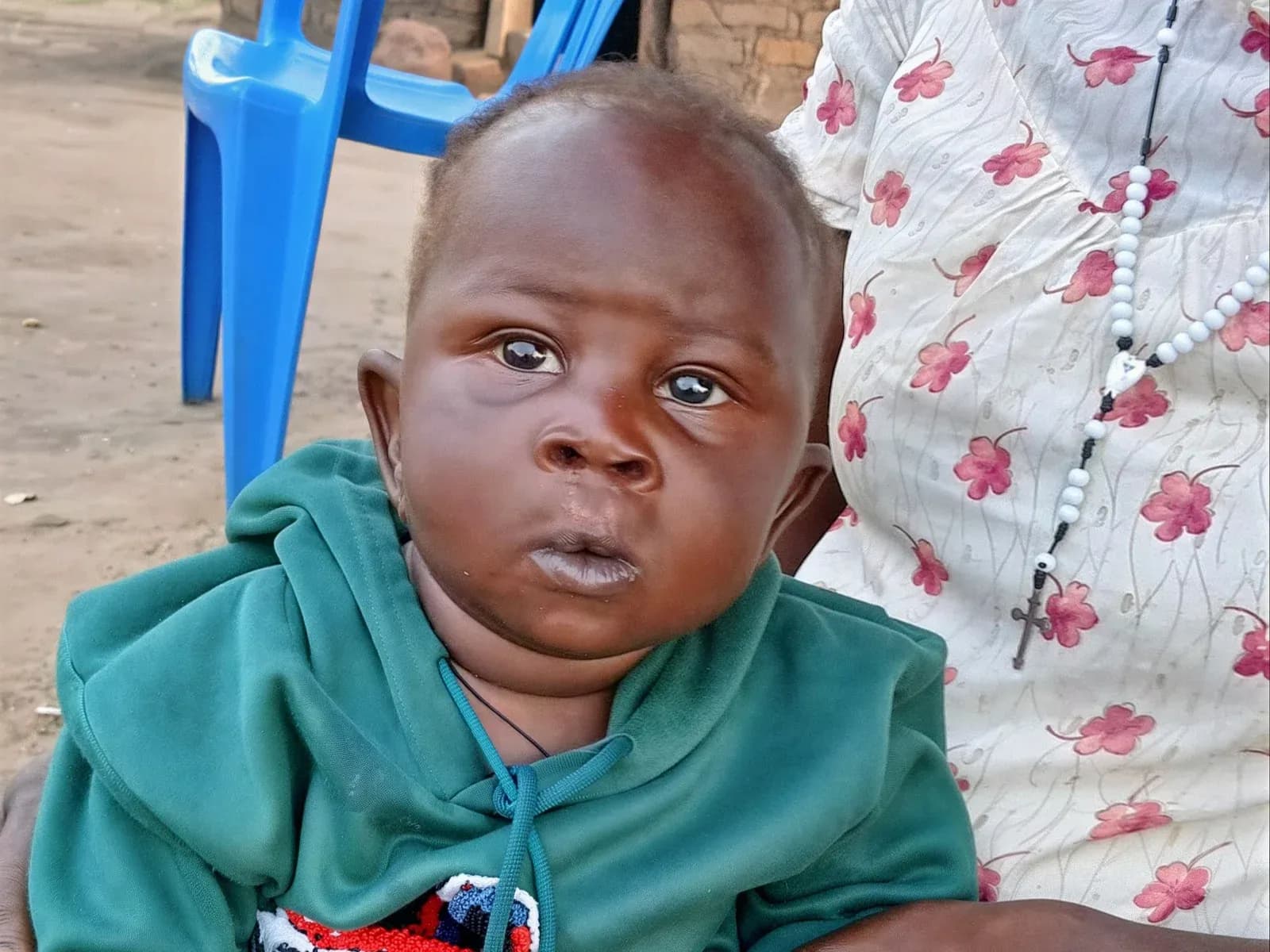 OJOK after his first cleft palate surgery, Northern Uganda